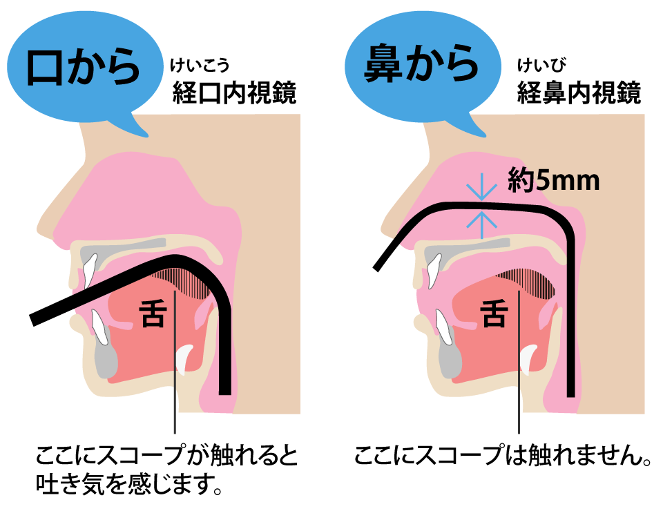 経鼻内視鏡